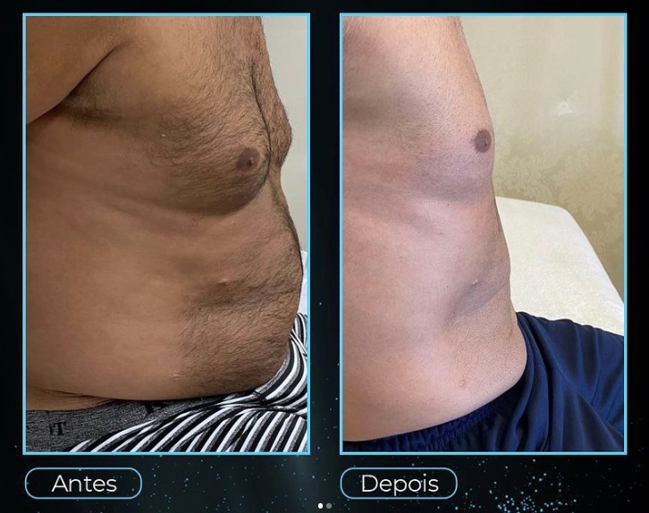 Registro de evolução do contorno abdominal masculino